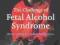 THE CHALLENGE OF FETAL ALCOHOL SYNDROME Kanter